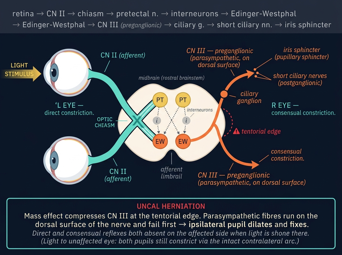 Diagram of the pupillary light reflex arc: light enters left eye, signal travels via CN II to the optic chiasm, then bilaterally to pretectal nuclei and interneurons to both Edinger-Westphal nuclei in the midbrain, then efferent CN III preganglionic fibres on the dorsal surface to the ciliary ganglion, then short ciliary nerves to the iris sphincter producing both direct and consensual constriction. Tentorial edge warning marker indicates the uncal herniation lesion site. Header shows the full pathway sequence.