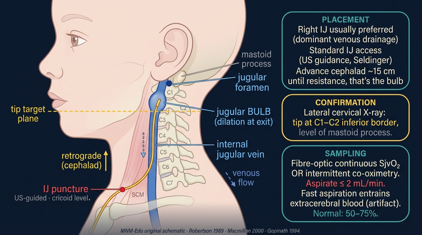 Lateral neck view showing the internal jugular vein draining from the jugular bulb at the base of the skull, with a retrograde catheter advanced cephalad through the IJ to the bulb at C1-C2 inferior border level. Sternocleidomastoid muscle, mastoid process, and C1-C7 cervical vertebrae labelled. Right panel: placement, confirmation, and sampling instructions.